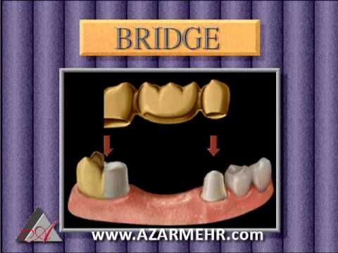 Bridge for teeth Los Angeles Dentist