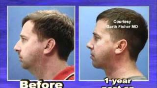 NT Vol. 4 Ch. 8 - Chin Augmentation