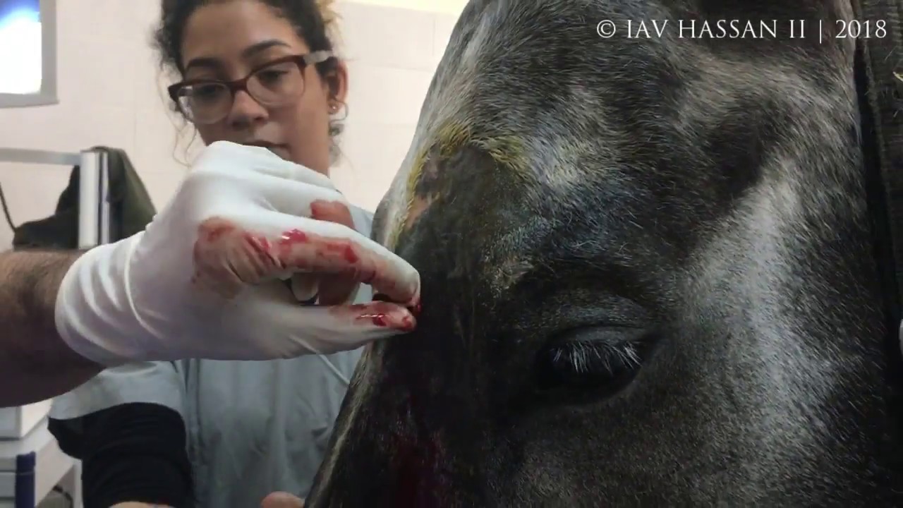 Surgical treatment of mycotic sinusitis - YouTube