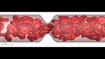 3D simulation of the flow of red blood cells in a stenosed microvessel