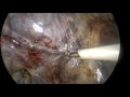Laparoscopic cholecystectomy ( 2ducts 0f LUSCHKA? ).