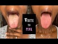 HOW TO GET RID OF WHITE TONGUE 👅 (A SELF-CARE VIDEO)