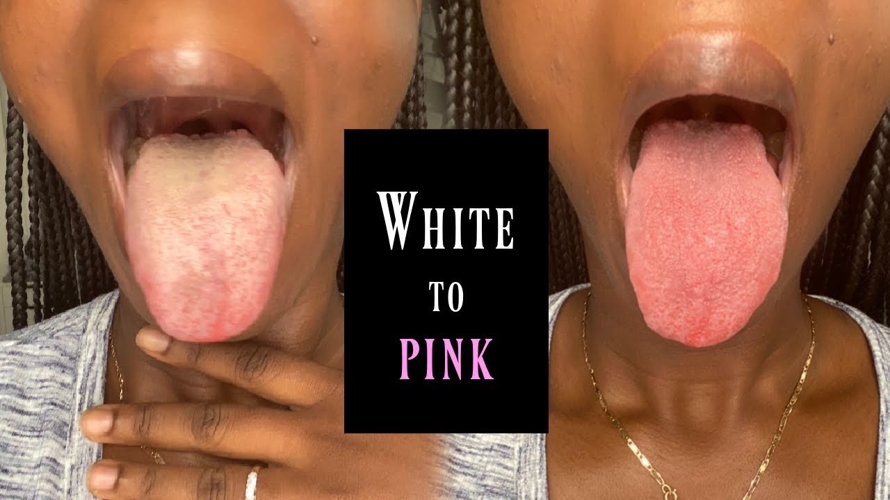 How To Get Rid Of White On Tongue