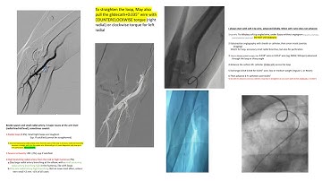 Radial loops- Difficult radial, subclavian and aortic anatomy: step-by-step, cases, perforation