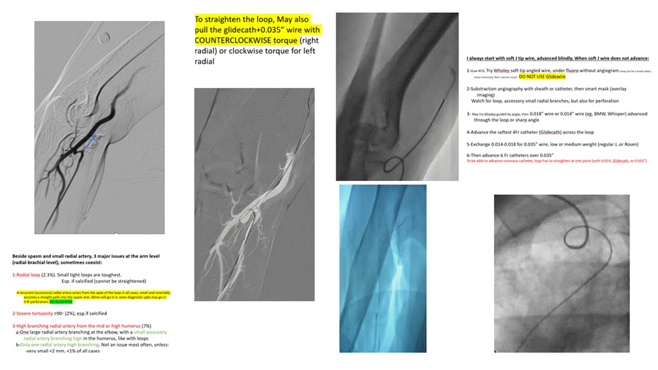 Small arteries, big trouble