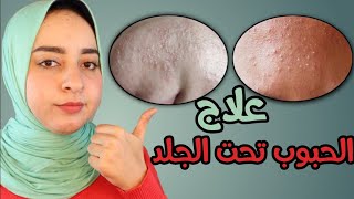 اسرع علاج لحبوب الجبهه والحبوب تحت الجلد | دكتور منة علي 🌸