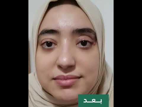 علاج جحوظ العين