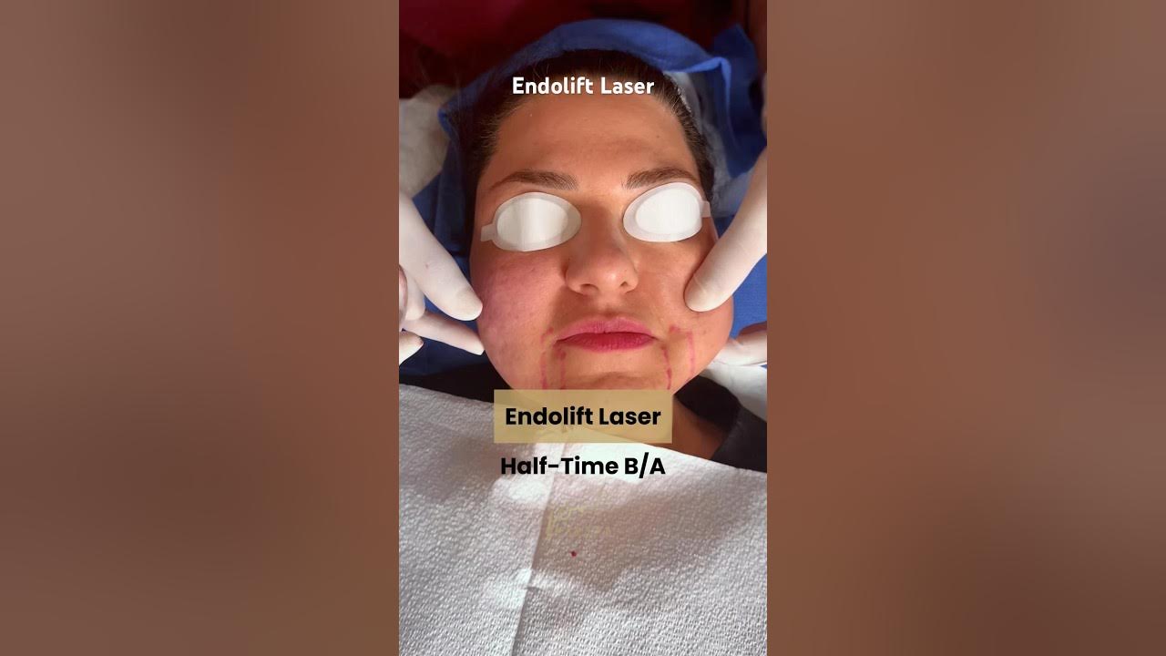 Endolift Laser Treatment Before and After, PCH MedSpa, Orange County YouTube