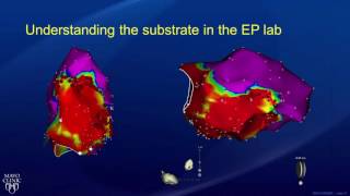 Ablation: Treatment for Ventricular Tachycardia  Part 2