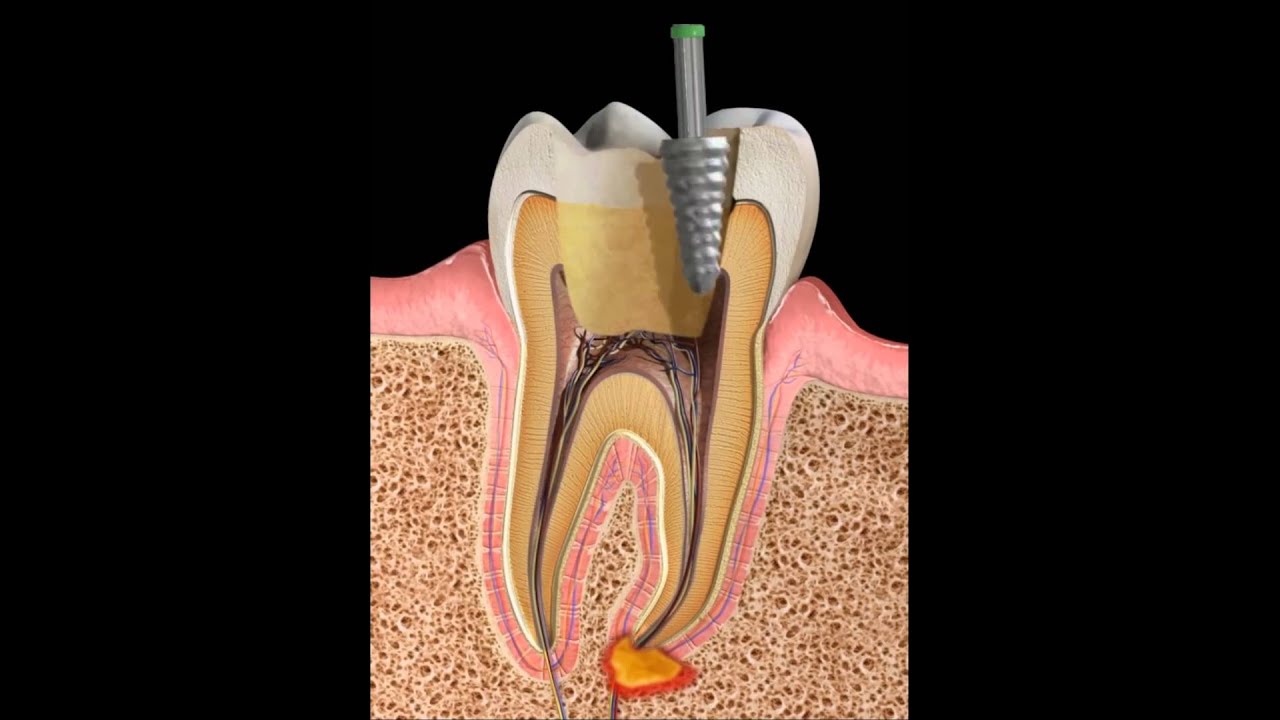 Endodoncia (Tratamiento de conducto) YouTube