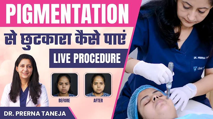 How to get rid of pigmentation? | Skin Pigmentation Removal Live Treatment | Clinic Eximus