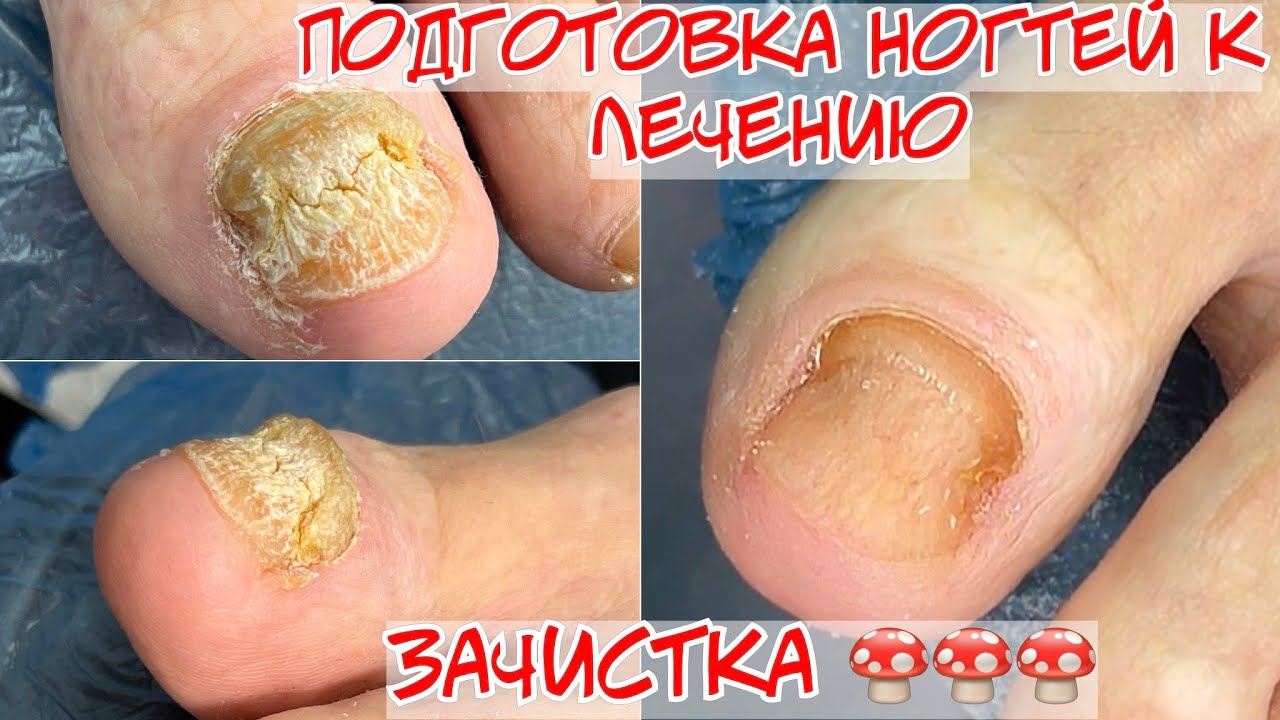 Зачистка ногтя при кератозе 🍄 Подготовка ногтей перед лечением