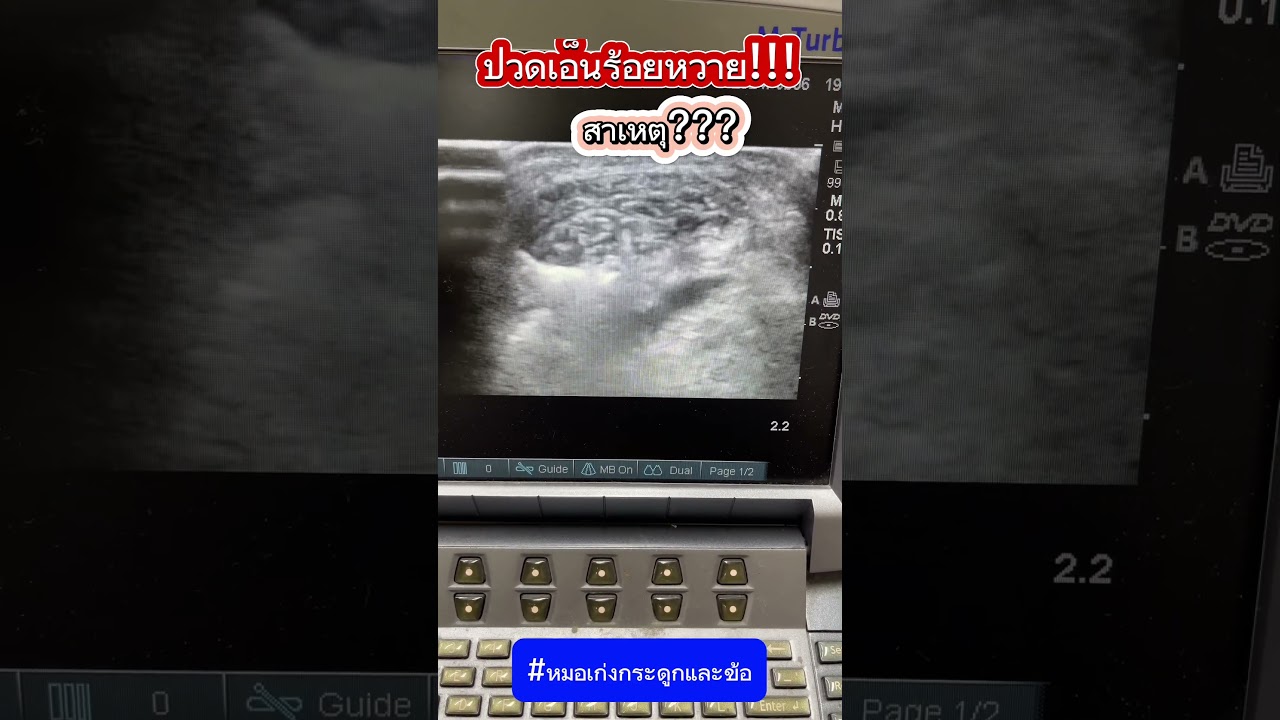 ปวดเอ็นร้อยหวาย สาเหตุ? #หมอเก่งกระดูกและข้อ #ปวดเอ็นร้อยหวาย #ปวดส้นเท้า #เอ็นร้อยหวายอักเสบ