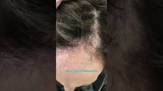 Tratamiento para Caída de Pelo - Dr. Angélica Domínguez Dermatóloga en bogotá