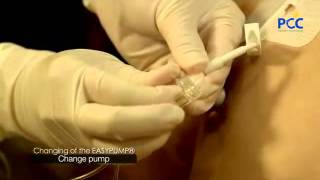 Dolor externa de bomba