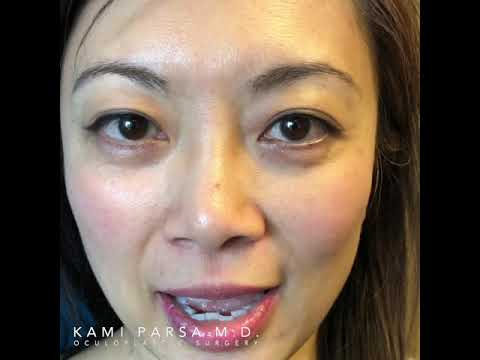 dr parsa oculoplastic dr parsa oculoplastic