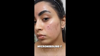 VAMPIRE FACIAL ? MICRONEEDLING !!