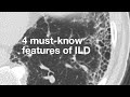 4 Must-Know Features of ILD