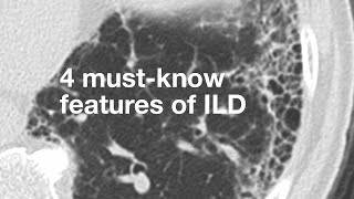 4 Must-Know Features of ILD