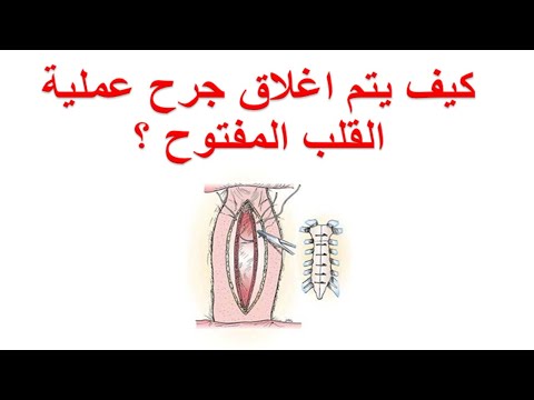 كيف يتم اغلاق جرح عملية القلب المفتوح ؟ خطوات اغلاق عظمة القص و جرح جراحة القلب