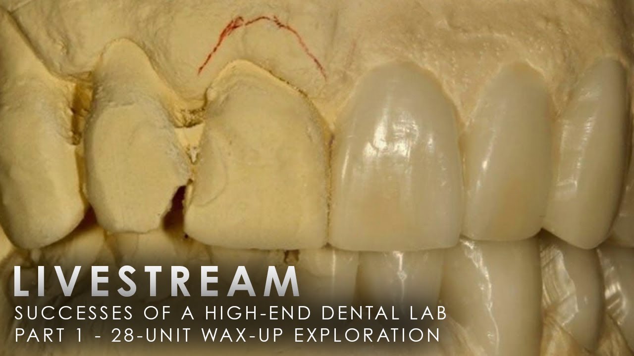 Successes of a HighEnd Dental Lab Part 1 28Unit WaxUp Exploration YouTube