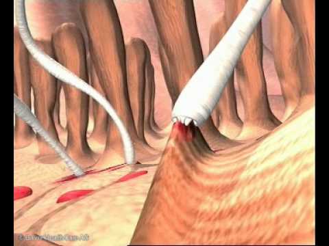 고양이 구충 - Ancylostoma tubaeforme