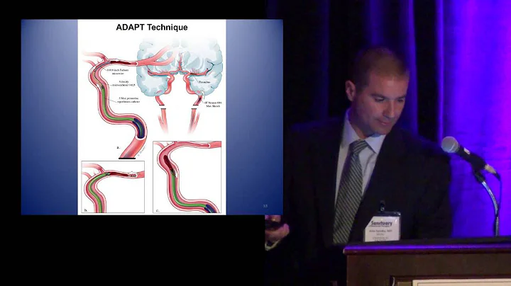 Update on Management of Acute Stroke - DayDayNews