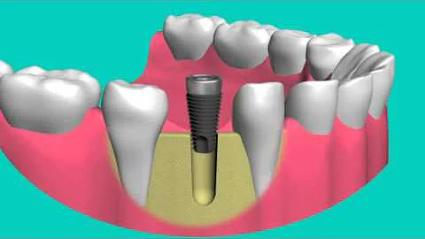 Dr. Vahadi Shares Placement of Dental Implant s in Frisco Tx