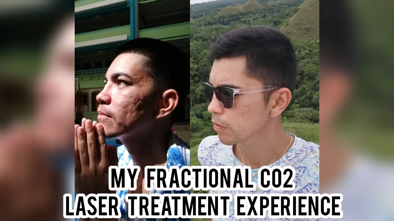 MY FRACTIONAL Co2 LASER TREATMENT