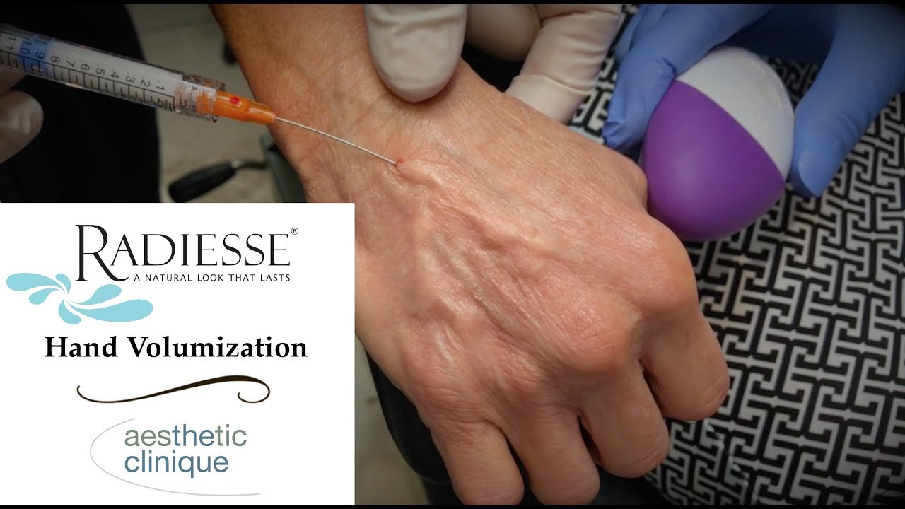 Radiesse Volumization of the Hands