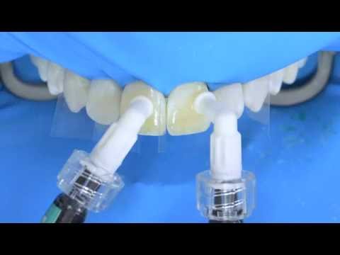 Video: Dental Fluorose - Behandling, Symptomer