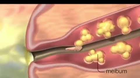 Do I have mites on my eyelids & eyelashes? Demodex Blepharitis can cause redness, dryness, itchiness