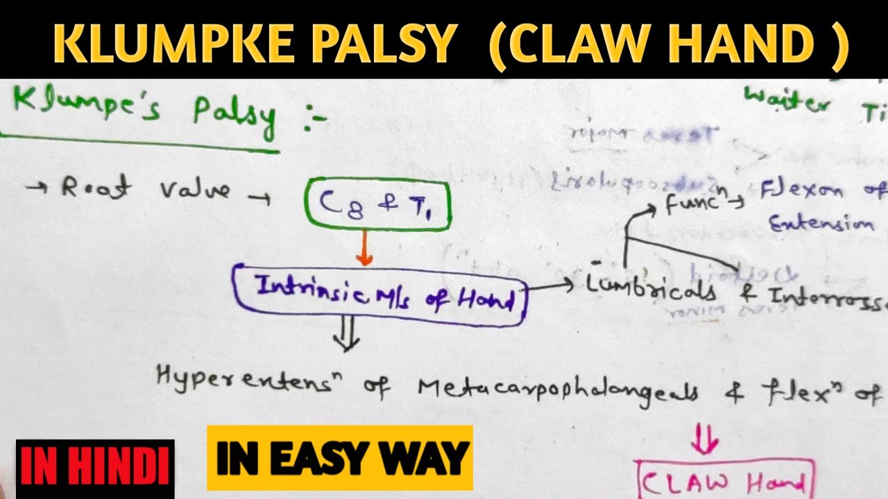 Klumpkes Palsy Claw Hand