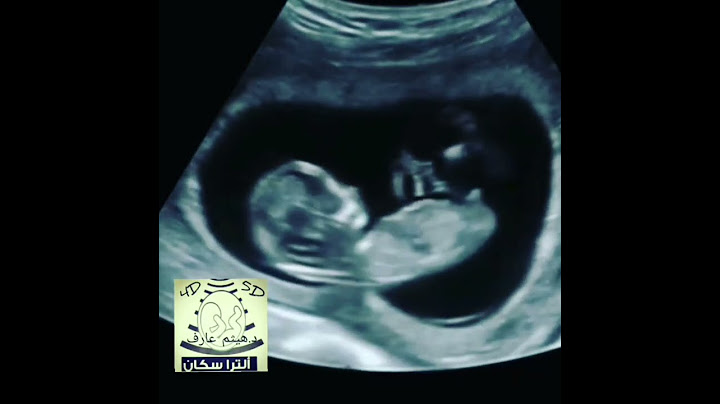 ولد و لا بنت بالسونار؟🤔🤔