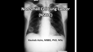 Non Small Cell Lung Cancer  Part 1