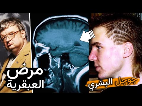 أذكى رجل في العالم | متلازمة العبقري