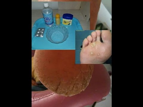 varice sous le pied varice sous le pied
