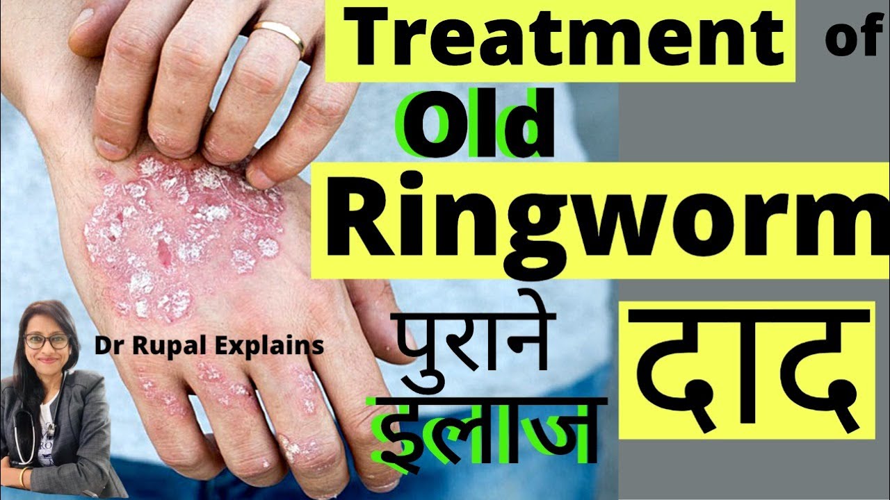 Old Ringworm Black Mark On My Skin पुराना दाद है लेकिन क्रीम लगाने पर