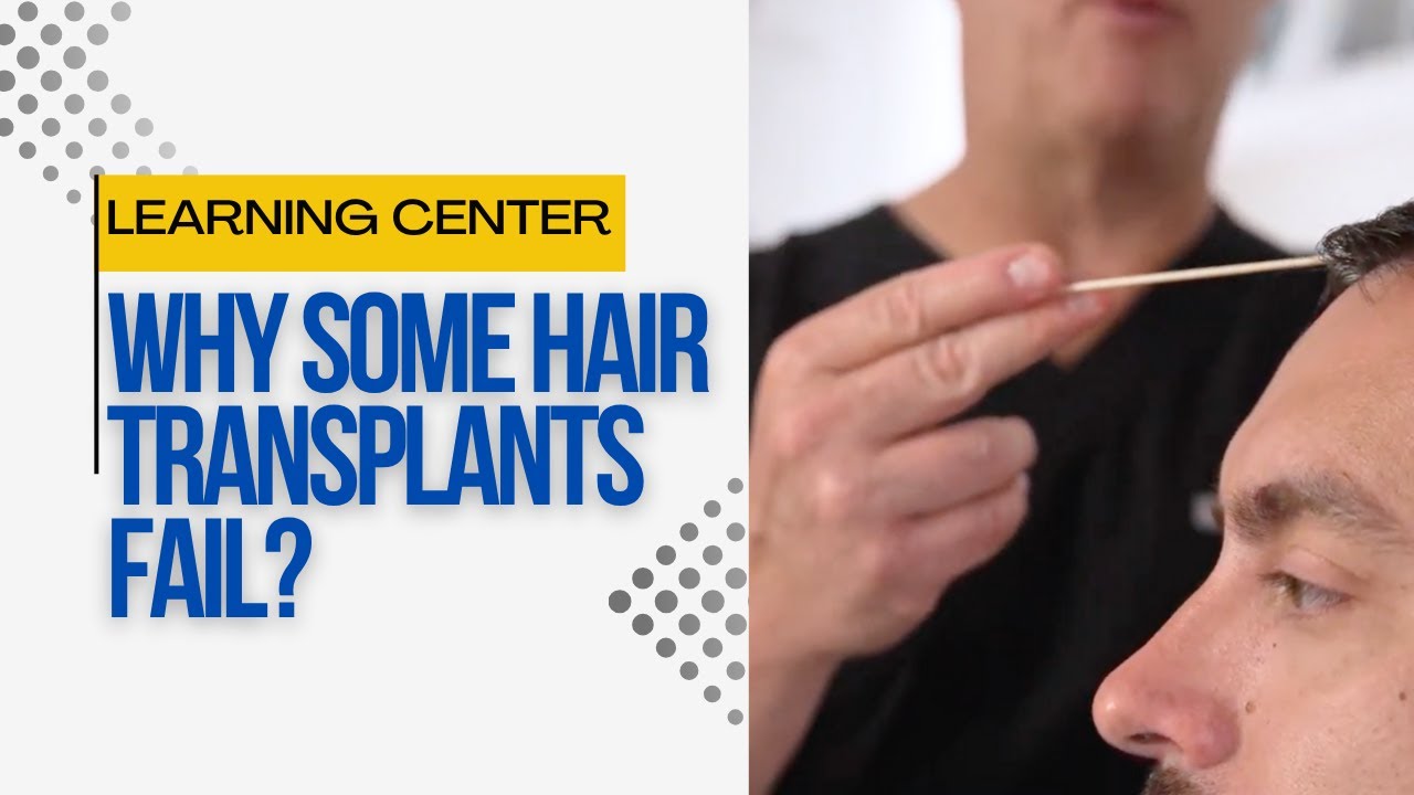 Hair Transplant Gone Wrong? Here’s What Really Causes Failure.