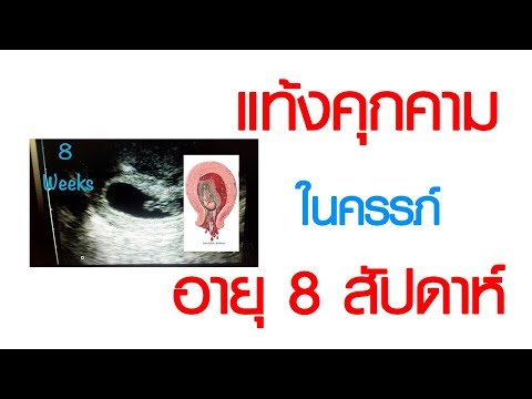 พบหมอเสรี ตอนที่ 193 : แท้งคุกคามในครรภ์อายุ 8 สัปดาห์