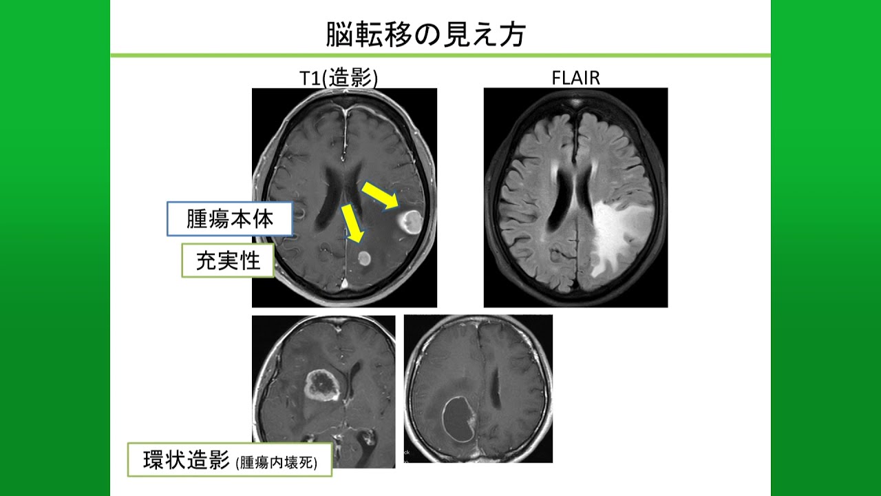 癌 脳 に 転移 余命