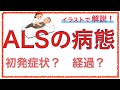 教科書をわかりやすく！「筋萎縮性側索硬化症とは」ALSの初期症状や病態をわかりやすく解説！