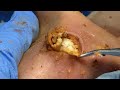 [ASMR] Sharp Ingrown Trimmed! Professional Pedicure DR LEE’S ULTIMATE ZITPOPPER 0509IPX IMG 3613