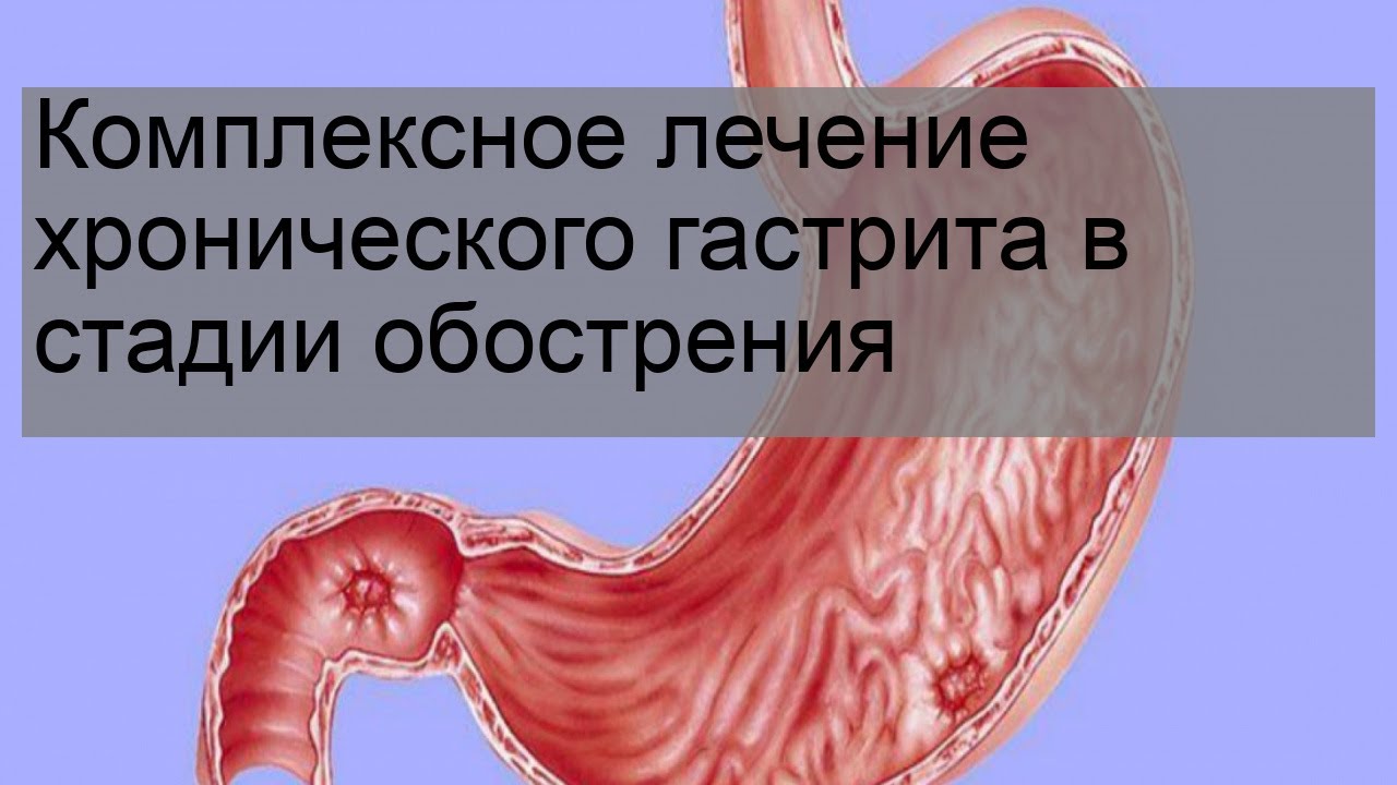 Комплексное лечение хронического гастрита в стадии обострения