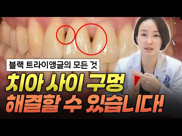 () 교정을 했는데 치아 사이에 구멍이 생긴 것 같으신가요? 치간삭제와 블랙트라이앵글에 대해서 모든 것을 알려드립니다.