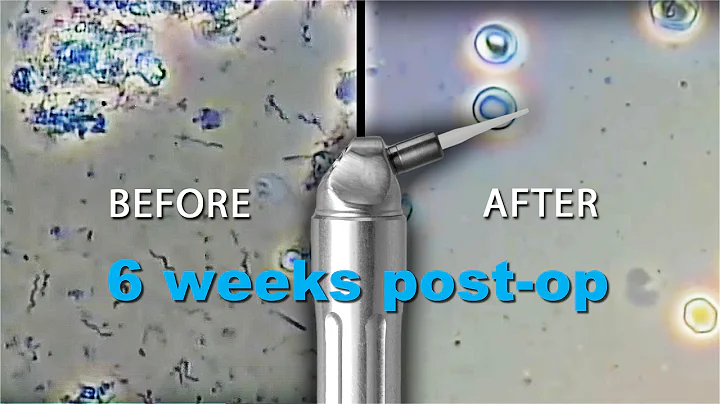 Spirochetes Killed 6 Week Post Op (Part 3 of 3)