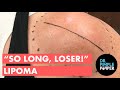 The "So Long, Loser!" Lipoma