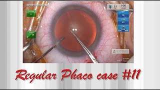 Regular Phaco case 11