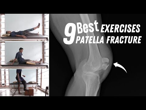 9 Best Patella Fracture Recovery Exercises after broken kneecap surgery