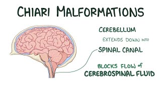Chiari Malformation Type 1 - My story What led to my diagnosis of having Chiari.
